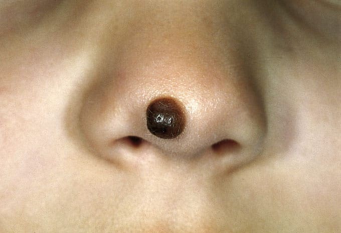 Mole removal – Which is the best way?