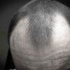 hair loss