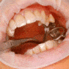 CEREC inlay