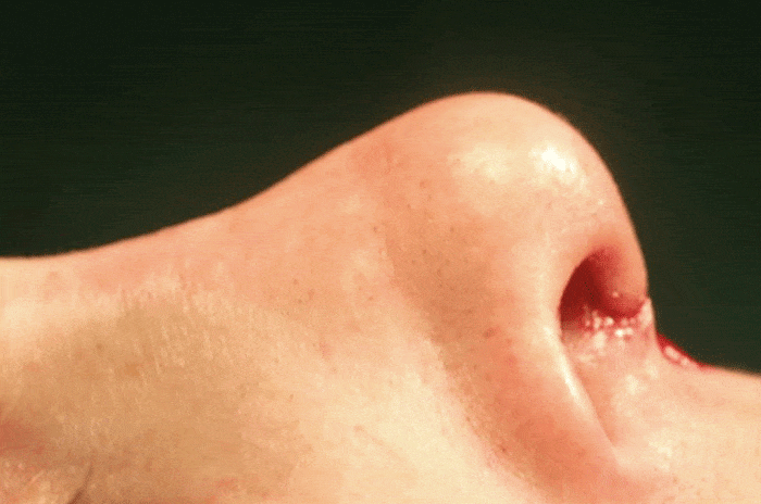 How snorting cocaine can seriously damage your nose
