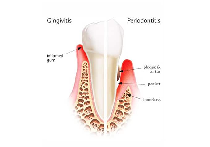 The link between gum disease and Alzheimer’s disease