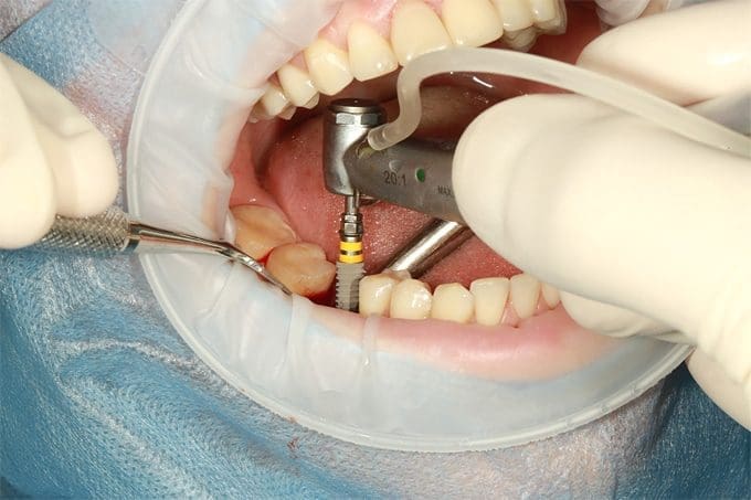 Dental Implants cost