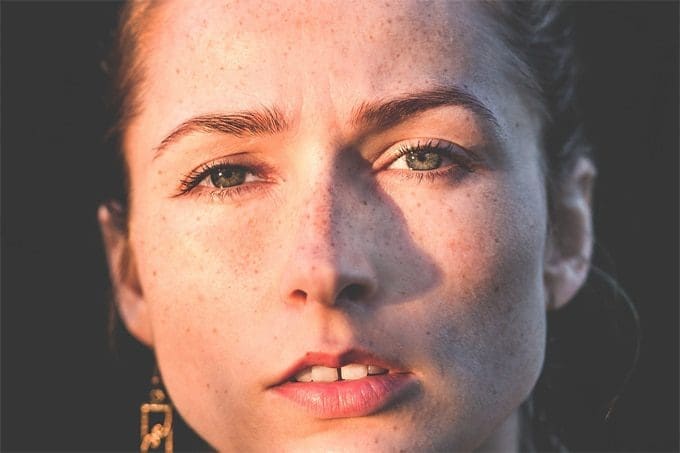 skin Hyperpigmentation