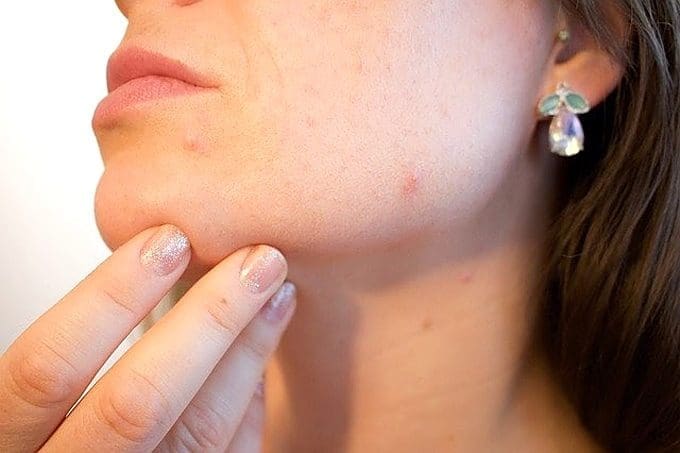 Expert Tips for Dealing With Acne Problems