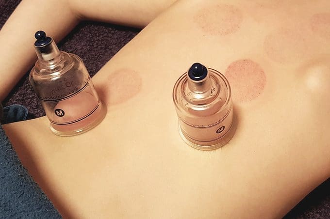 Cupping therapy: Is it as painful as it looks?
