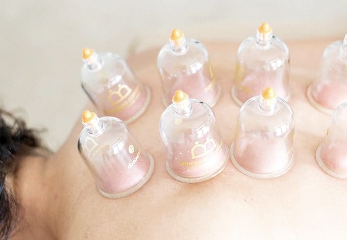 Cupping therapy