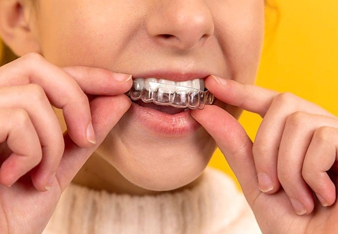 Can Adults Wear Braces? Let’s Dispel Some of the Common Myths