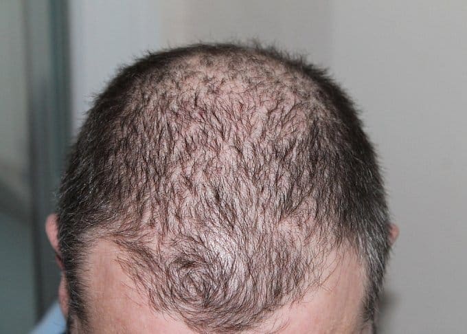 Hair Loss tips