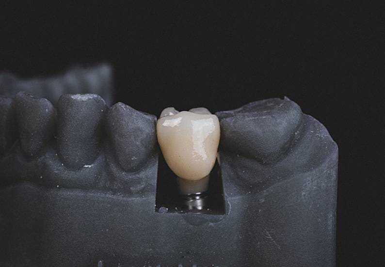 Questions to Ask Your Dental Implant Dentist: Dr. Dennis Norkiewicz, DDS